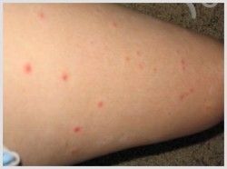Bed Bug Bites